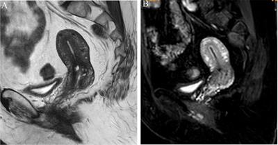 Peritumoral Enhancement for the Evaluation of <mark class="highlighted">Myometrial Invasion</mark> in Low-Risk Endometrial Carcinoma on Dynamic Contrast-Enhanced MRI